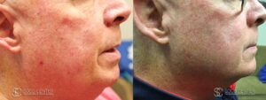 IPL Treatment Before and After Photo - Patient 5B