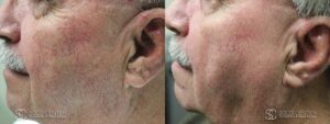IPL Treatment Before and After Photo - Patient 6A