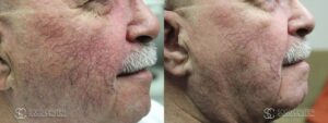 IPL Treatment Before and After Photo - Patient 6B