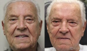 IPL Treatment Before and After Photo - Patient 8A