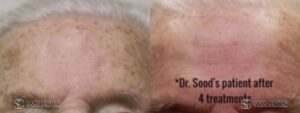 IPL Treatment Before and After Photo - Patient 8B