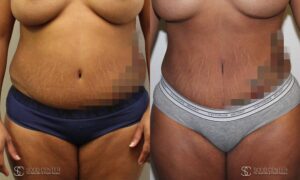 Liposuction Before and After Photos - Patient 3B