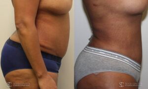 Liposuction Before and After Photos - Patient 3B