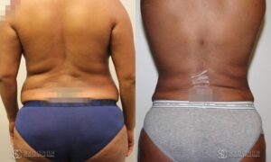 Liposuction Before and After Photos - Patient 3C