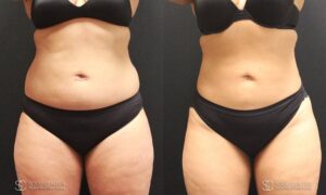 Liposuction Before and After Photos - Patient 4A