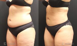 Liposuction Before and After Photos - Patient 4B