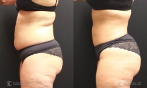 Liposuction Before and After Photos - Patient 4C