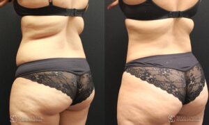 Liposuction Before and After Photos - Patient 4D