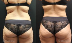 Liposuction Before and After Photos - Patient 4E