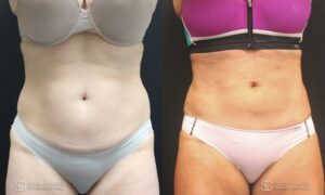 Liposuction Before and After Photos - Patient 5A