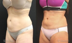 Liposuction Before and After Photos - Patient 5B