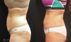 Liposuction Before and After Photos - Patient 5C