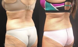 Liposuction Before and After Photos - Patient 5D
