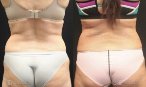 Liposuction Before and After Photos - Patient 5E