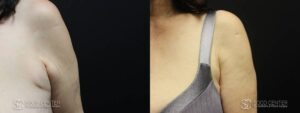 Liposuction Before and After Photos - Patient 6A