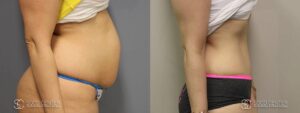 Tummy Tuck Before and After Photos - Patient 7A