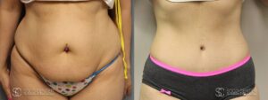 Tummy Tuck Before and After Photos - Patient 7B
