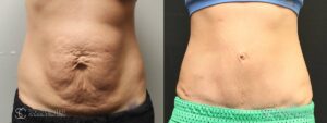 Tummy Tuck Before and After Photos - Patient 8A