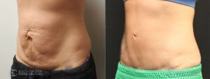 Tummy Tuck Before and After Photos - Patient 8B