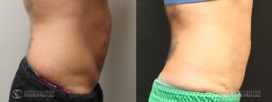 Tummy Tuck Before and After Photos - Patient 8C