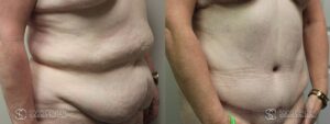 Tummy Tuck Before and After Photos - Patient 10C
