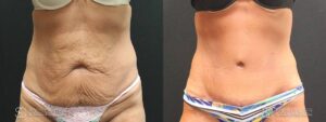 Tummy Tuck Before and After Photos - Patient 11A
