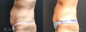 Tummy Tuck Before and After Photos - Patient 11B