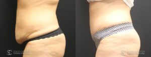 Tummy Tuck Before and After Photos - Patient 12B