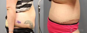 Tummy Tuck Before and After Photos - Patient 1A
