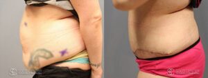 Tummy Tuck Before and After Photos - Patient 1B