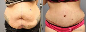Tummy Tuck Before and After Photos - Patient 1C