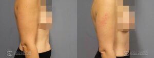 Tummy Tuck Before and After Photos - Patient 2A