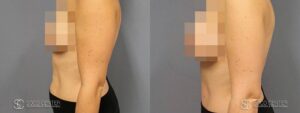 Tummy Tuck Before and After Photos - Patient 2B