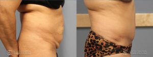 Tummy Tuck Before and After Photos - Patient 4A