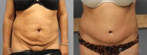 Tummy Tuck Before and After Photos - Patient 4B