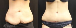 Tummy Tuck Before and After Photos - Patient 5A
