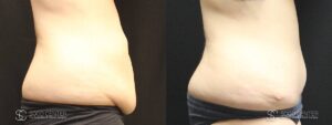 Tummy Tuck Before and After Photos - Patient 5B