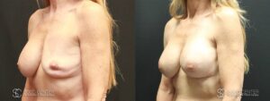 Breast Revision Before and After Photo - Patient 2B