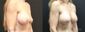 Breast Revision Before and After Photo - Patient 2C