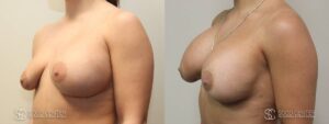 Breast Revision Before and After Photo - Patient 3B