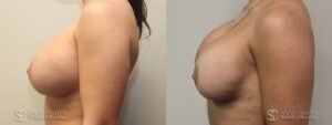 Breast Revision Before and After Photo - Patient 3C