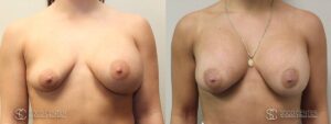 Breast Revision Before and After Photo - Patient 3A
