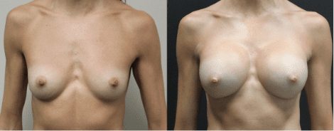 Breast Augmentation Before & After Gallery Section Photo