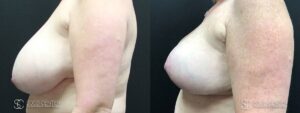Breast Reduction Before and After Photos - Patient 1C