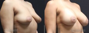 Dual-Plane Breast Augmentation Before and After Photo - Patient 6B