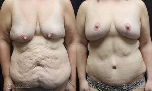 Body Contouring Before and After Photo - Patient 2A