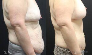 Body Contouring Before and After Photo - Patient 2C