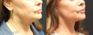 Facelift Before and After Photo - Patient 1A