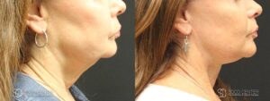 Facelift Before and After Photo - Patient 1B