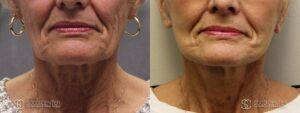 Facelift Before and After Photo - Patient 2A